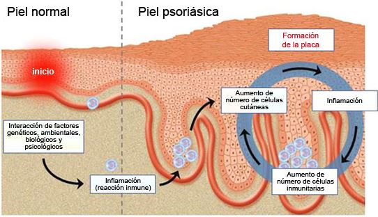psoriasis2