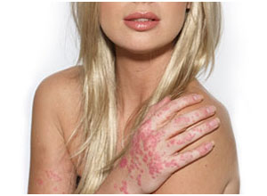 psoriasis3